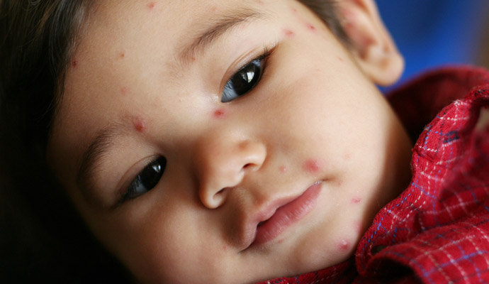 Toddler boy with chicken pox